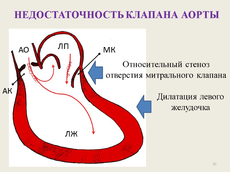 20 НЕДОСТАТОЧНОСТЬ КЛАПАНА АОРТЫ